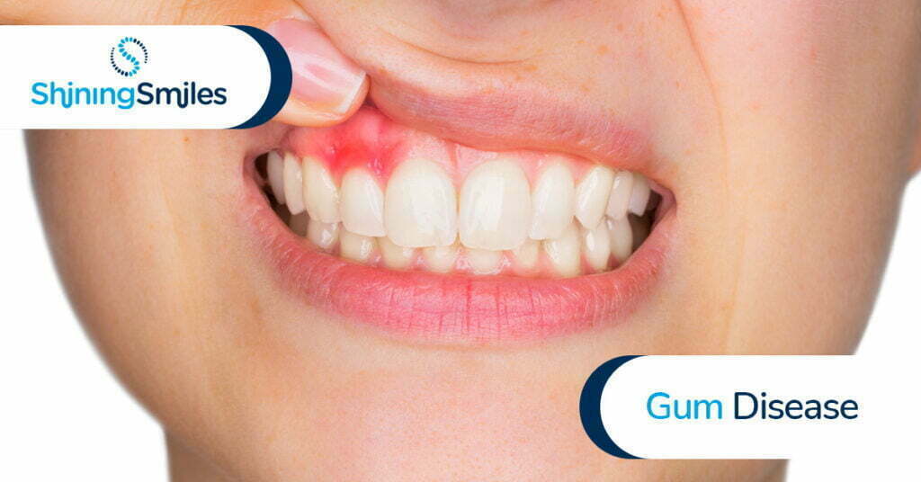 Gum disease treatment in Marietta.