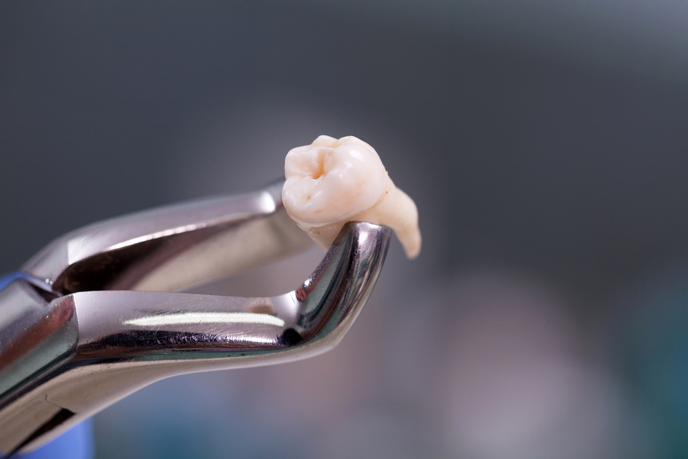 Marietta tooth extraction guidance